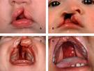 Cleft Palate