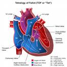 Congenital Heart Disease