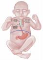 Esophageal and Intestinal Atresia