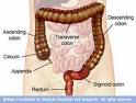 Hirschsprung's Disease