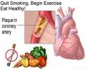 Ischemic Heart Disease