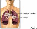 LungCancer.jpg