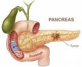 Pancreas Cancer