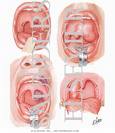 Pharynx Cancer