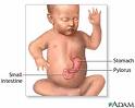 PyloricStenosis.jpg