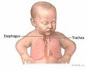 TracheoesophagealFistula.jpg